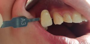 Traitement implantaire : couleur de la dent - Marquant