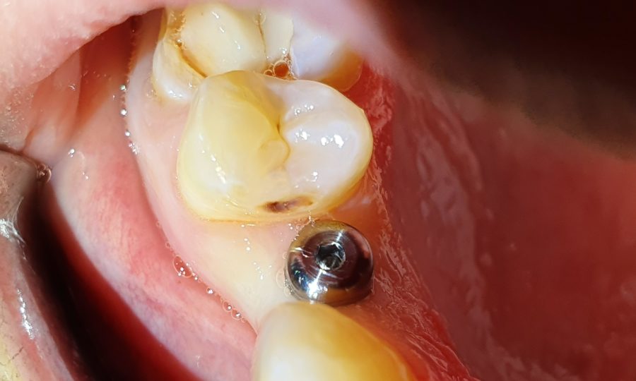 implant dentaire à lille Docteurs Marquant